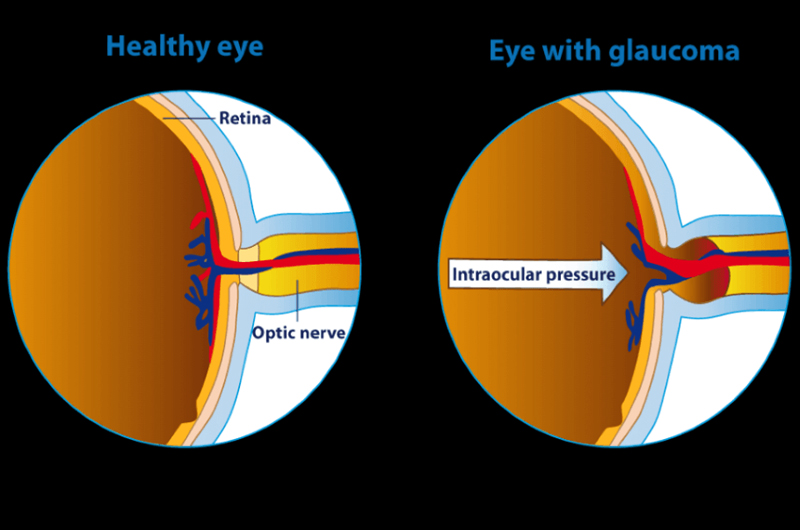 New Genetic Discoveries Shed Light On Glaucoma Risk In People Of