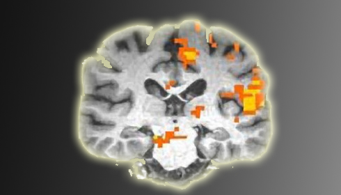 Brain scan showing Gulf War Syndrome