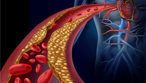 European Researchers Come Together to Combat Atherosclerosis, The Silent Killer