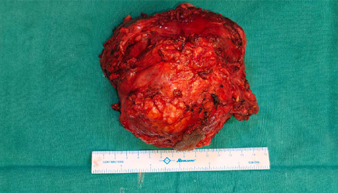 Gurgaon Doctors Remove 8.5-kilogram Overian Tumour from a 13-year-old girl