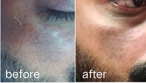 Skin Pgmentation (L) & Post Treatment