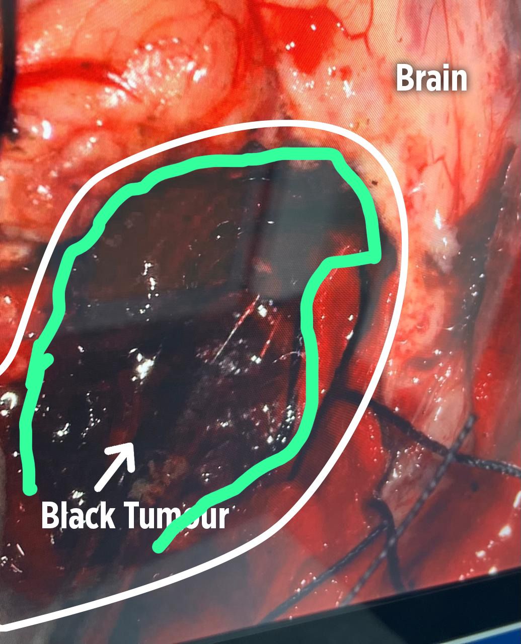 Black Tumor