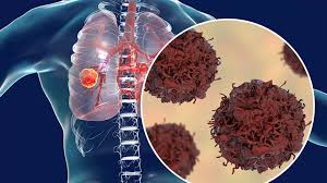 Vitamin B3 Shows Promise in Reducing Lung Inflammation in COPD Patients