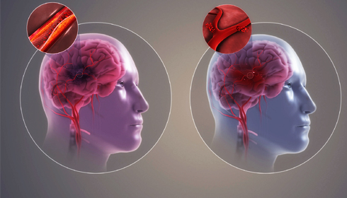 Study Links Antihypertensive Treatments to Post-stroke Epilepsy Risk