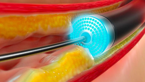 Revolutionary Laser Patterning Technology to Enhance Vascular Recovery