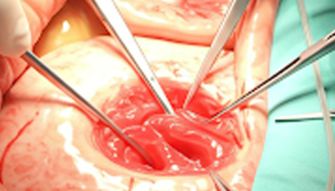 New Gene Clue May Help Predict Severe Crohn's and Colitis Years Earlier, Landmark Study Finds