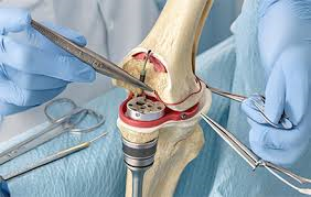 Knee Surgery May Not Always Help Arthritis Patients; Study Raises Questions Over Common Meniscus Procedure